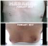 February_2016_to_February_2017_my_new_tits_.jpg